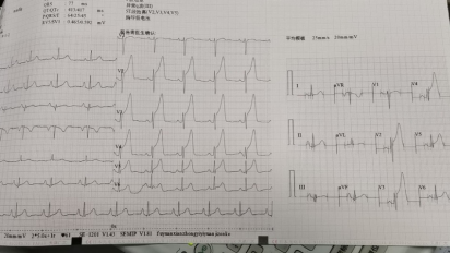 静脉溶栓，基层医院治疗急性ST段抬高型心肌梗死的不二选择(图2)